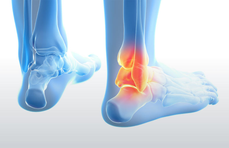 Image of Ankle Injury